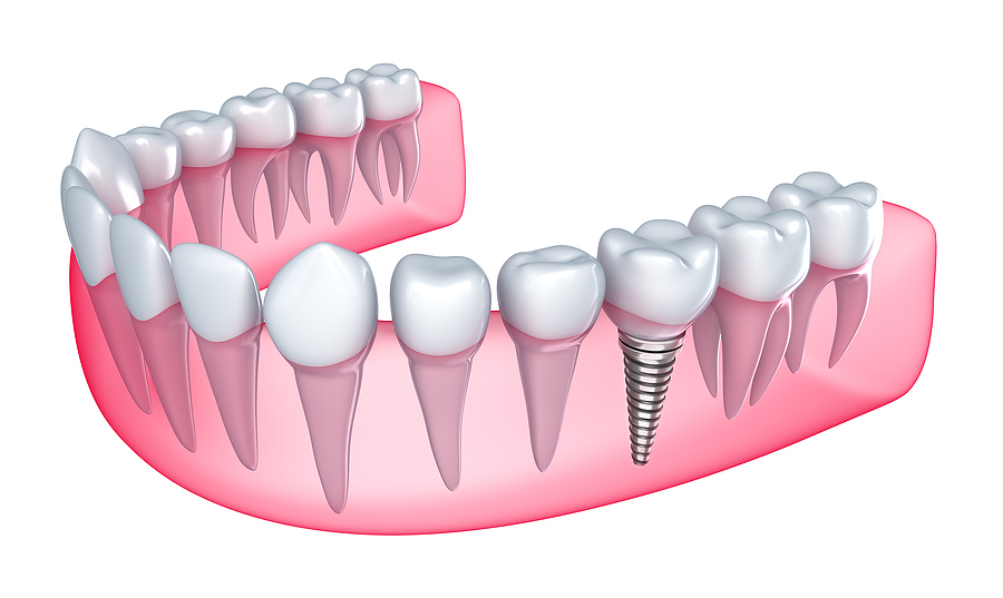 Revolutionize Your Smile: Discover Dental Implants in Palo Alto, CA