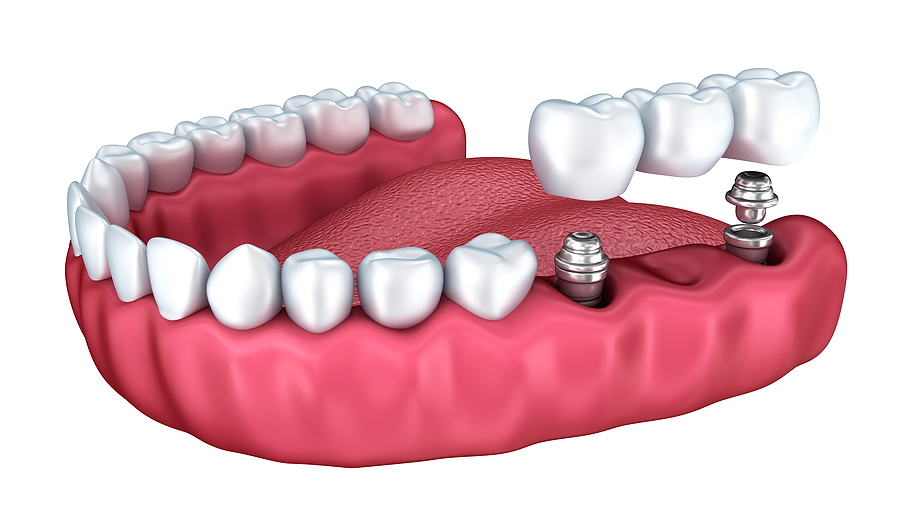 The Ultimate Guide to Dental Implants in Santa Clara, CA